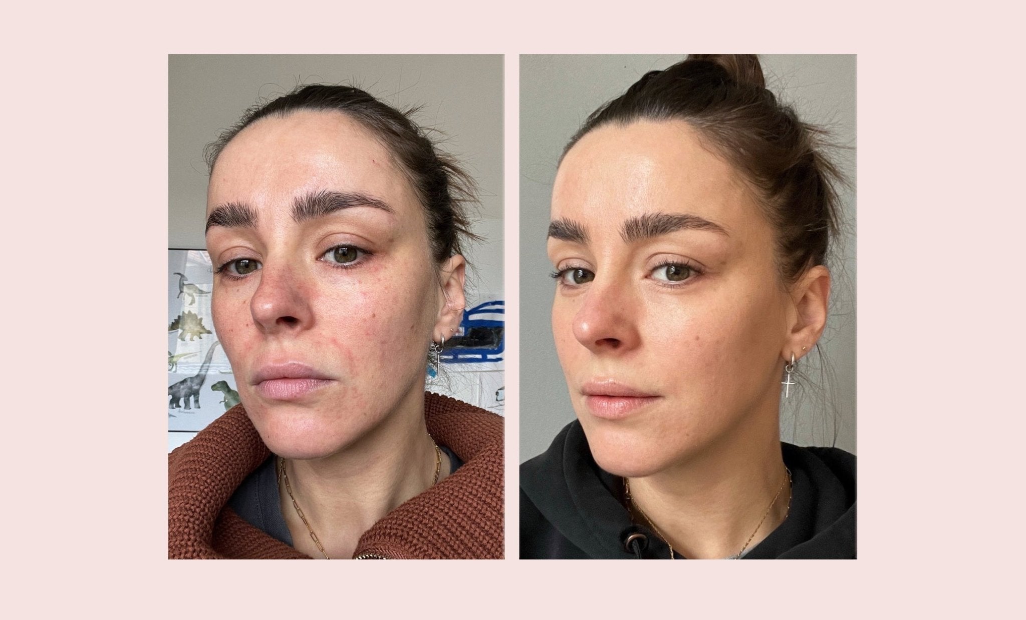 Skinstory – Egal was ich unternahm, nichts half! - VENYA